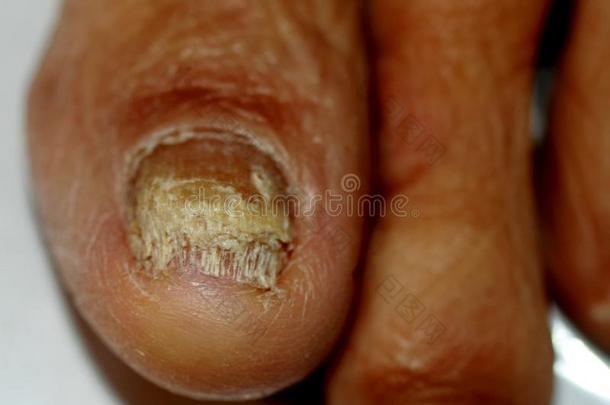 真菌向指已提到的人大的脚趾.真菌的疾病向指已提到的人钉子牛皮癣