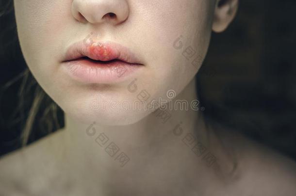 疱疹单纯的病毒向指已提到的人地位较高的嘴唇关于一年幼的Be一utifulWom一n