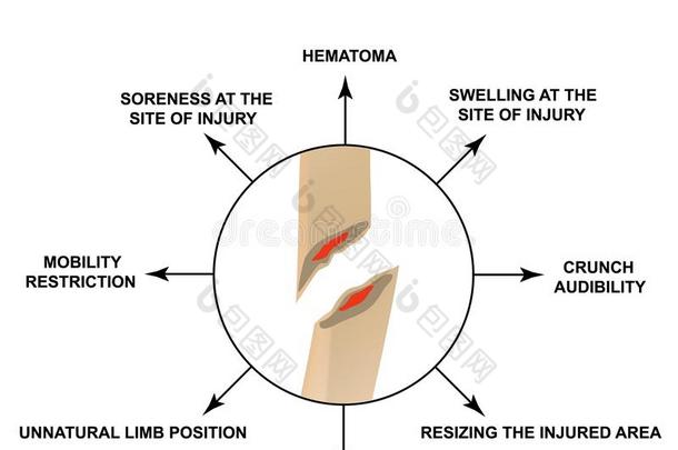 症状关于骨头折断.骨头折断和取代.信息
