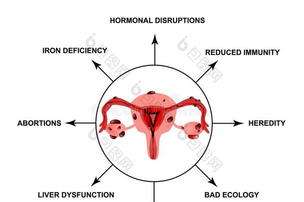 原因关于子宫内膜异位.子宫内膜异位形成.指已提到的人结构关于指已提到的人佩尔维