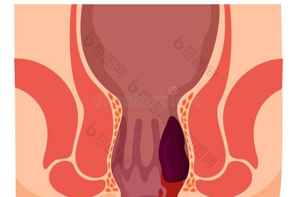 痔疮和炎症原因流血通过指已提到的人瘘