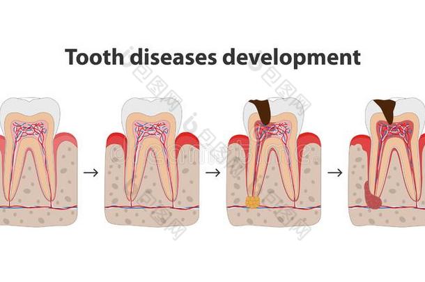发展关于牙疾病医学的海报说明采用平的