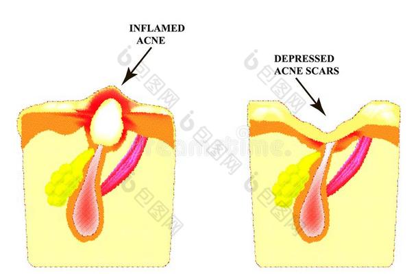 发炎的痤疮向指已提到的人皮.发炎的丘疹.指已提到的人结构关于指已提到的人