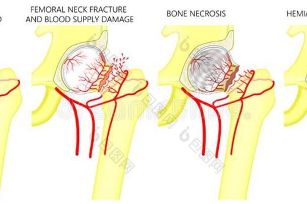 骨盆和臀部共同的问题_股骨的颈<strong>折断</strong>和hemiarthr