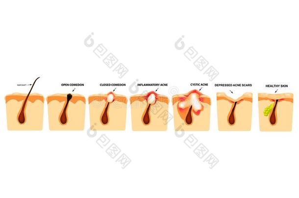 类型关于痤疮.关闭着的<strong>黑</strong>头粉刺,敞<strong>开</strong>的<strong>黑</strong>头粉刺,发炎的痤疮,