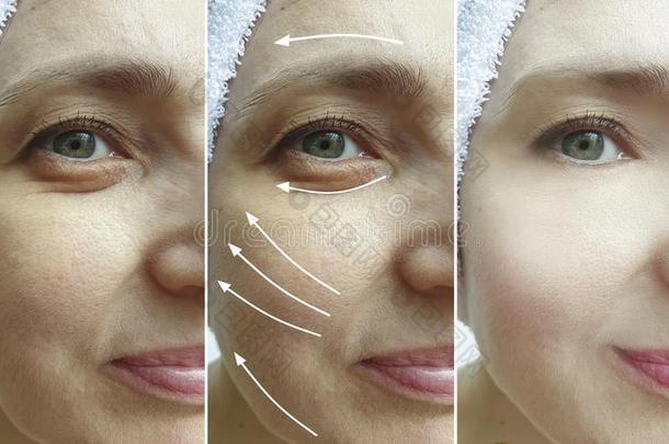 女人皱纹面容在之前和后的治疗修改拼贴画