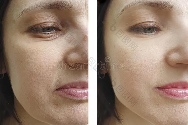 女人面容皱纹治疗<strong>修改</strong>在之前和后的治疗者