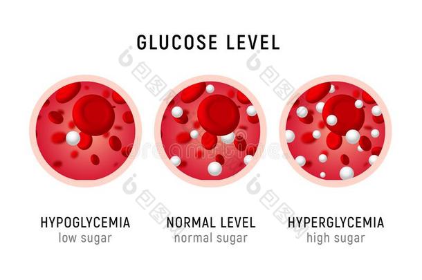 葡萄糖血水平食糖试验.糖尿病胰岛素<strong>血糖</strong>过低或