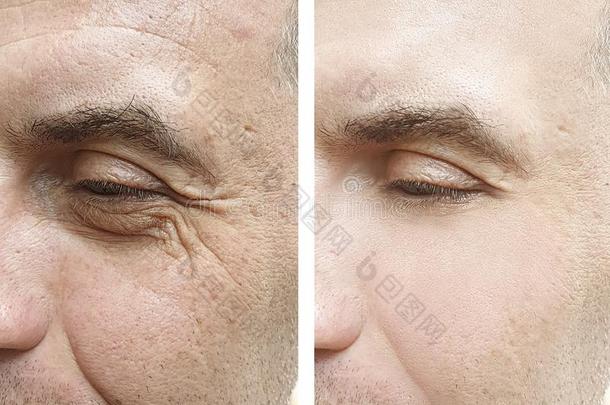 男人面容<strong>眼睛皱纹</strong>在之前和后的治疗