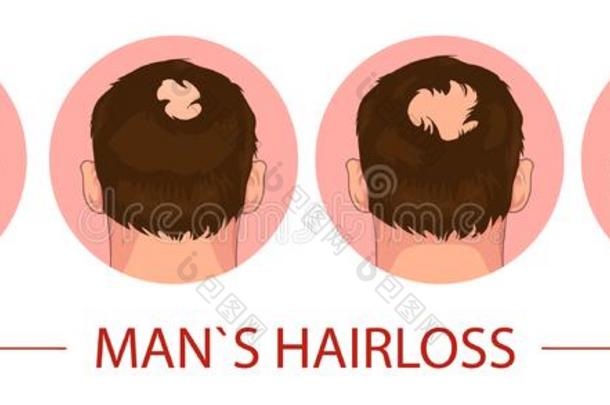 头发损失.台关于秃头症过程男人问题矢量医学的