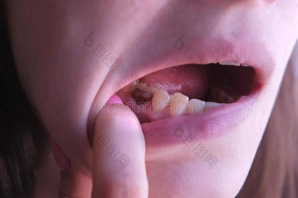 粉红色的牙和<strong>龋齿</strong>和治愈的和使用雷琐酚-福尔马林