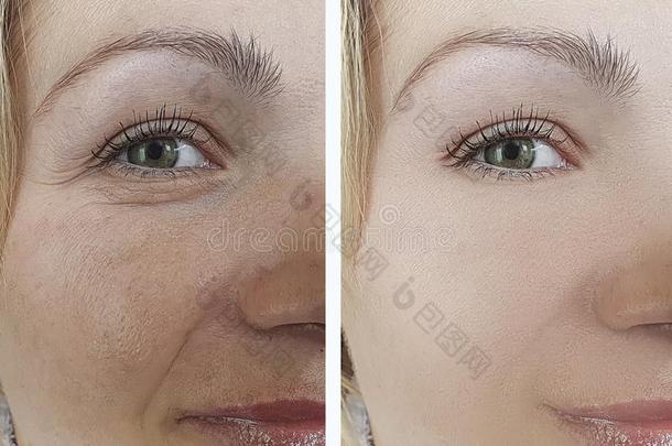 面容女人皱纹在之前和后的修改治疗