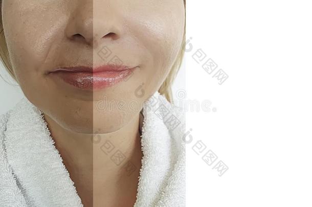 女人面容<strong>眼睛皱纹</strong>治疗修改在之前后的水合素
