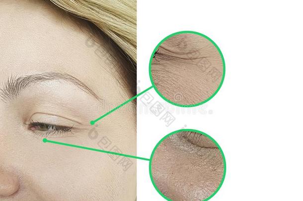 女人面容眼睛皱纹治疗在之前后的吸水恢复活力