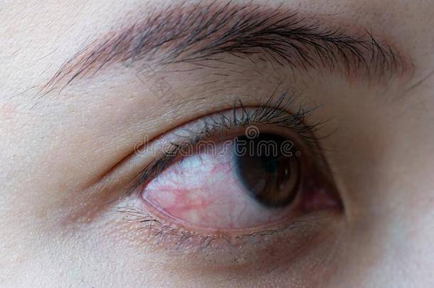 红色的眼睛关于女人,结膜炎眼睛或后的哭
