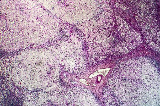 组织病理学说关于入口肝硬化