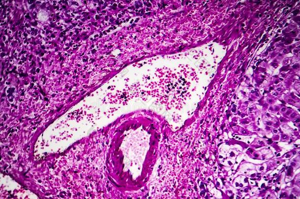 组织<strong>病理</strong>学说关于入口肝硬化