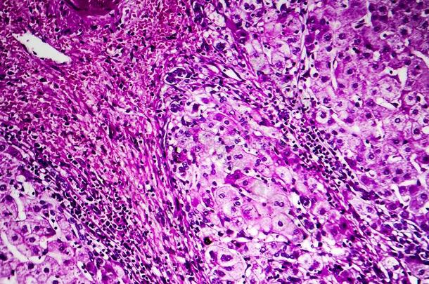 组织病理学说关于入口肝硬化
