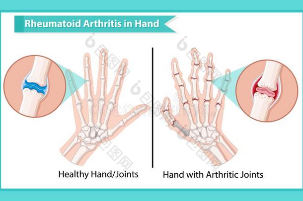 科学的医学的说明关于风湿病的关节炎