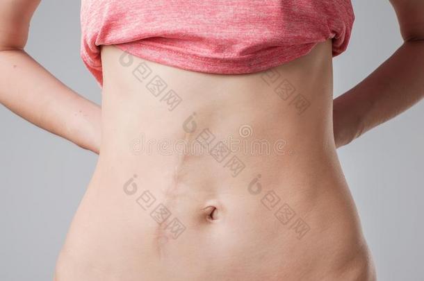 欧洲的女人和长的腹部的伤痕后的操作