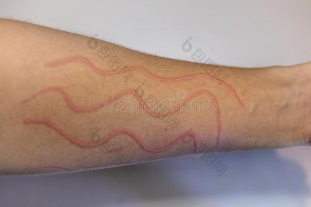 Dermatographic风疹也大家知道的同样地皮肤病,dermatogra