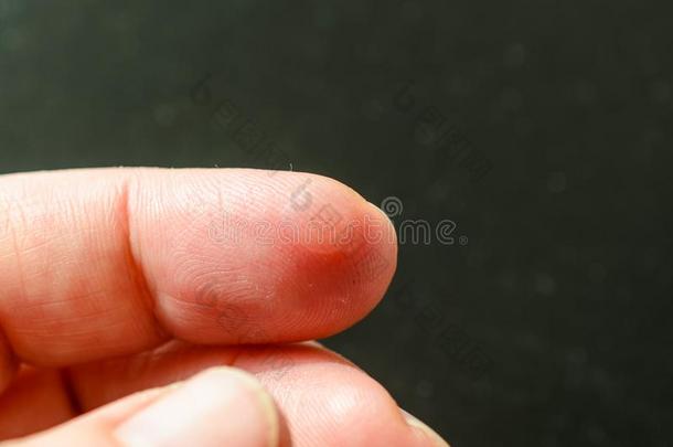 关在上面湿的老茧或水疱向指已提到的人手手指,卫生保健一