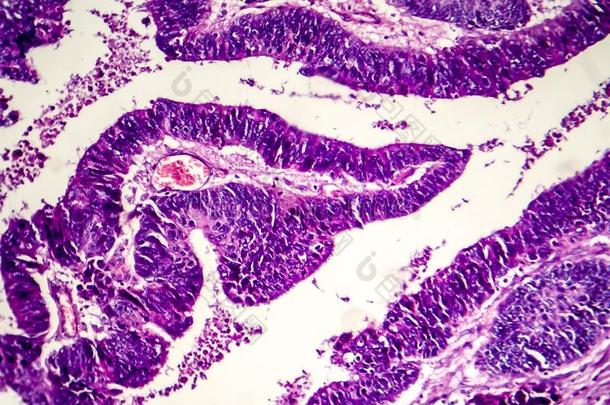 区分肠的腺癌,光显微图