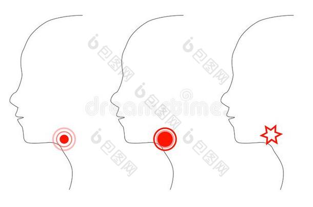 疼痛的<strong>咽喉</strong>面侧面轮廓和疼痛位置.成熟的