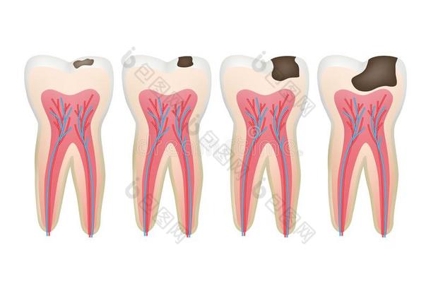 龋齿牙.腐烂讲坛牙齿的问题程序根矢量