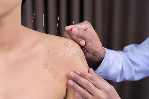 女人经历针灸治疗向肩膀