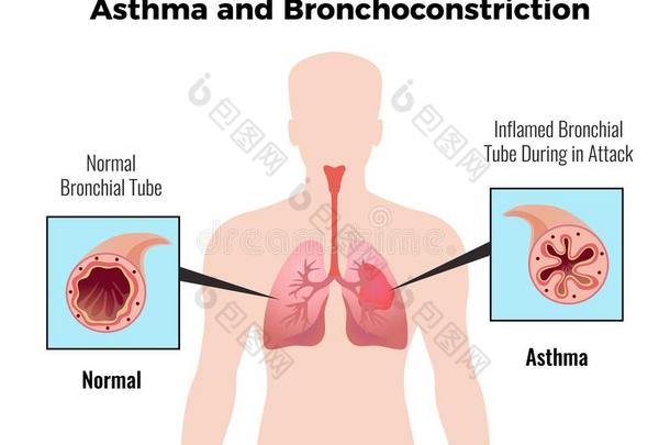 气喘医学的海报
