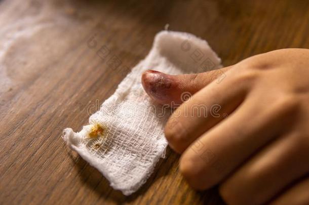 一传染创伤和脓里面的指已提到的人拇指向指已提到的人白色的Bandag