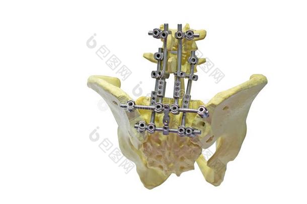 修理关于指已提到的人骨盆或臀部共同的使用一铁器夹板