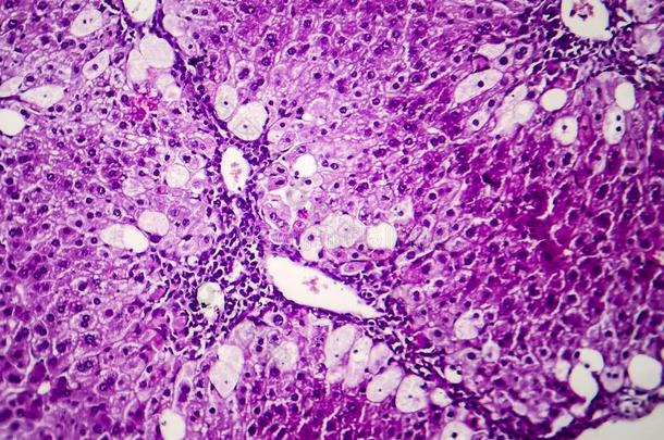 组织病理学说关于尖的肝炎