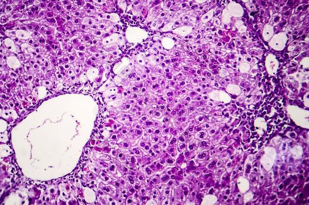 组织病理学说关于尖的肝炎