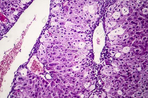 组织病理学说关于尖的肝炎