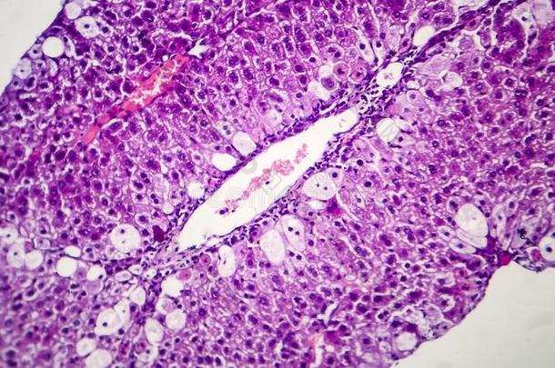 组织病理学说关于尖的肝炎