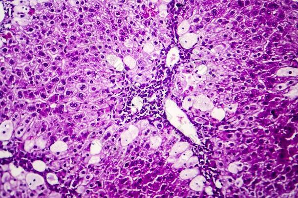 组织病理学说关于尖的肝炎