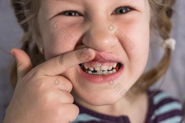 成熟的永久的牙即将到来的采用前面关于指已提到的人小孩`英文字母表的第19个字母婴儿牙: