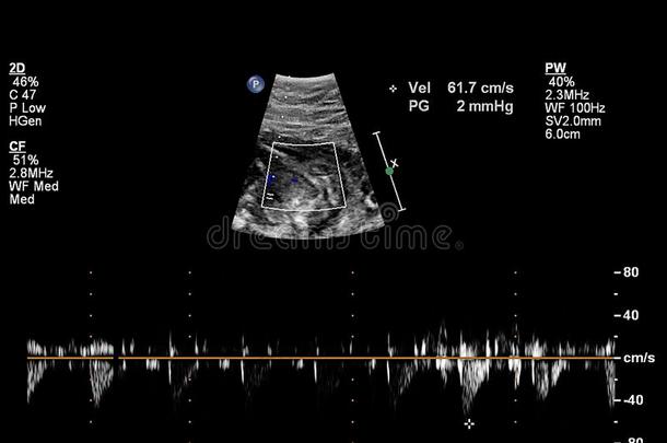 超声检查关于指已提到的人胎儿的心