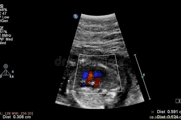 超声<strong>检查</strong>关于指已提到的人<strong>胎儿</strong>的心
