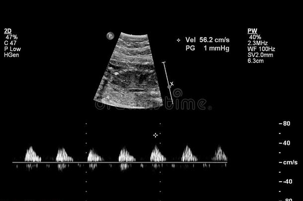 超声检查关于指已提到的人胎儿的心