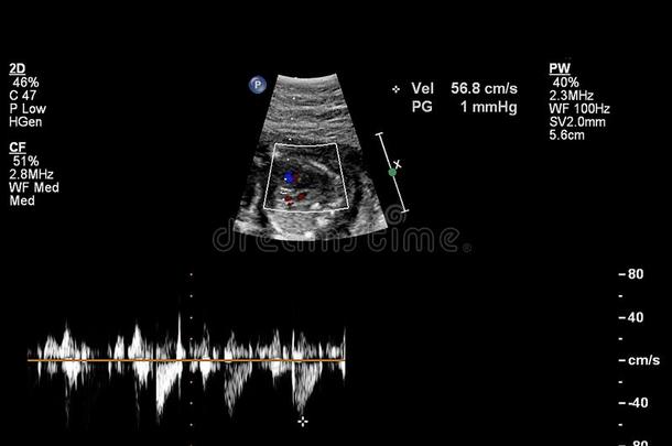 超声<strong>检查</strong>关于指已提到的人<strong>胎儿</strong>的心