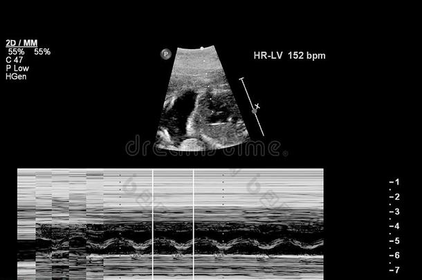 超声<strong>检查</strong>关于指已提到的人<strong>胎儿</strong>的心