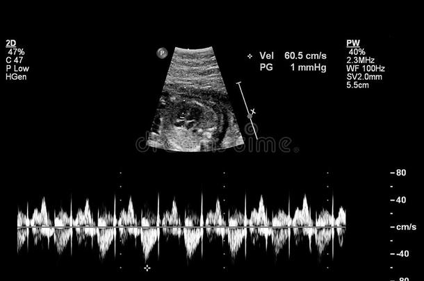 超声<strong>检查</strong>关于指已提到的人<strong>胎儿</strong>的心