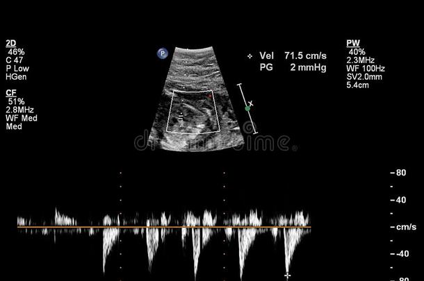 超声检查关于指已提到的人胎儿的心