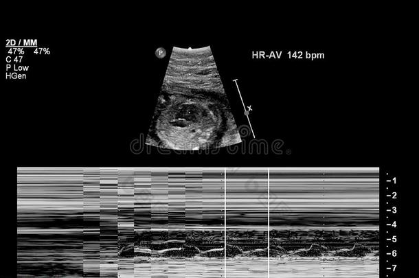 超声检查关于指已提到的人胎儿的心