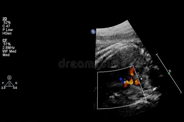 超声<strong>检查</strong>关于指已提到的人<strong>胎儿</strong>的心