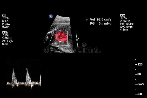 超声检查关于指已提到的人胎儿的心