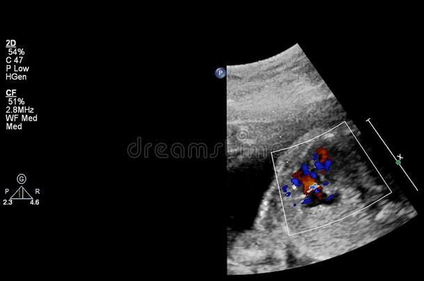 超声<strong>检查</strong>关于指已提到的人<strong>胎儿</strong>的心